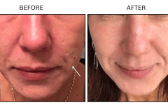 Lasers Laser Resurfacing Co2 Laser - Patient15