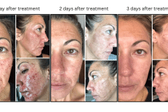 Lasers Laser Resurfacing Co2 Laser - Patient16
