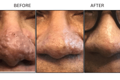 Lasers Laser Resurfacing Co2 Laser - Patient17