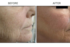 LB Lasers Laser Resurfacing Co2 Laser - Patient3
