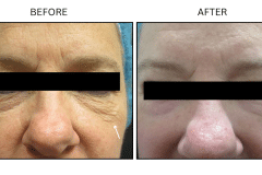 LB Lasers Laser Resurfacing Co2 Laser - Patient6b