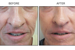 LB Lasers Laser Resurfacing Co2 Laser - Patient7c