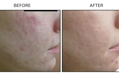 LB Lasers Laser Resurfacing Co2 Laser - Patient9