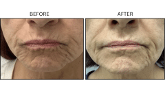 LB Neurotx Relx Lips - Patient1