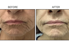 LB Neurotx Relx Lips - Patient1