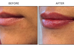 LB Fillers Lips - Patient19