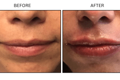LB Fillers Lips - Patient20