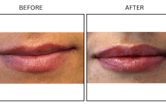 LB Fillers Lips - Patient21