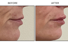 LB Fillers Lips - Patient22a