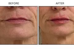 LB Fillers Lips - Patient22b