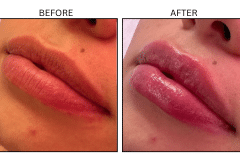 LB Fillers Lips - Patient23