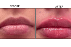 LB Fillers Lips - Patient24