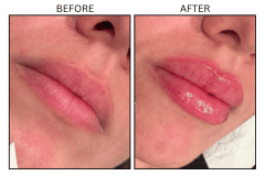 LB Fillers Lips - Patient25a