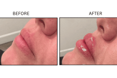 LB Fillers Lips - Patient25b
