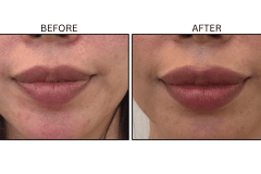LB Fillers Lips - Patient26