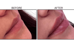 LB Fillers Lips - Patient27
