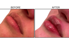 LB Fillers Lips - Patient28