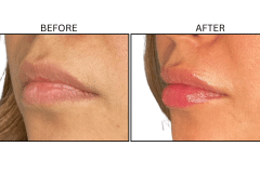 LB Fillers Lips - Patient29