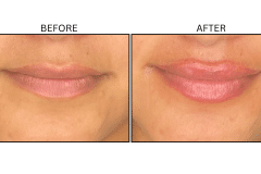 LB Fillers Lips - Patient30