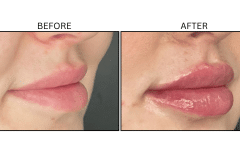 LB Fillers Lips - Patient31