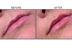 LB Fillers Lips - Patient32