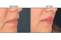 LB Fillers Lips - Patient33
