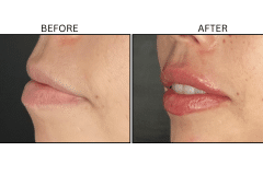 LB Fillers Lips - Patient34