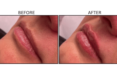 LB Fillers Lips - Patient35