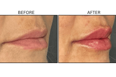 LB Fillers Lips - Patient36