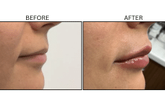 LB Fillers Lips - Patient37