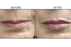 LB Fillers Lips - Patient38