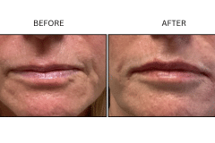 LB Fillers Lips - Patient39