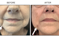 LB Fillers Marionette Lines - Patient3