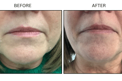 LB Fillers Marionette Lines - Patient4