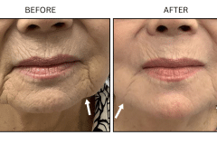 LB Fillers Marionette Lines - Patient5