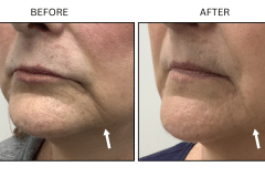 LB Fillers Marionette Lines - Patient6