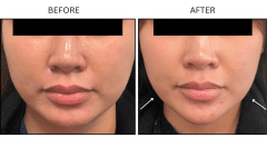 LB Neurotx Relx Masseter - Patient1