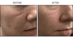 LB Microneedling Acne Scars - Patient11