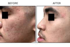LB Microneedling Acne Scars - Patient1