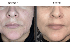 LB Microneedling Acne Scars - Patient2