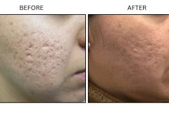 LB Microneedling Acne Scars - Patient3a