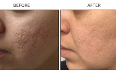 LB Microneedling Acne Scars - Patient3b