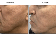 LB Microneedling Acne Scars - Patient4a