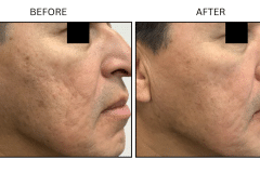 LB Microneedling Acne Scars - Patient4b