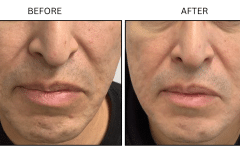 LB Microneedling Acne Scars - Patient4c