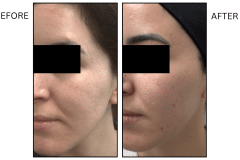 LB Microneedling Acne Scars - Patient10