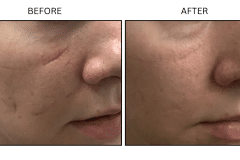 LB Microneedling Acne Scars - Patient11