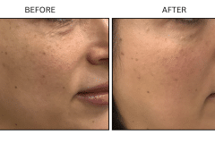 LB Microneedling Acne Scars - Patient5