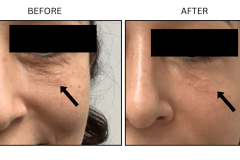 LB Microneedling Acne Scars - Patient6