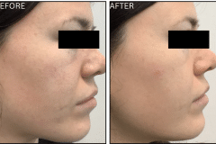 LB Microneedling Acne Scars - Patient7